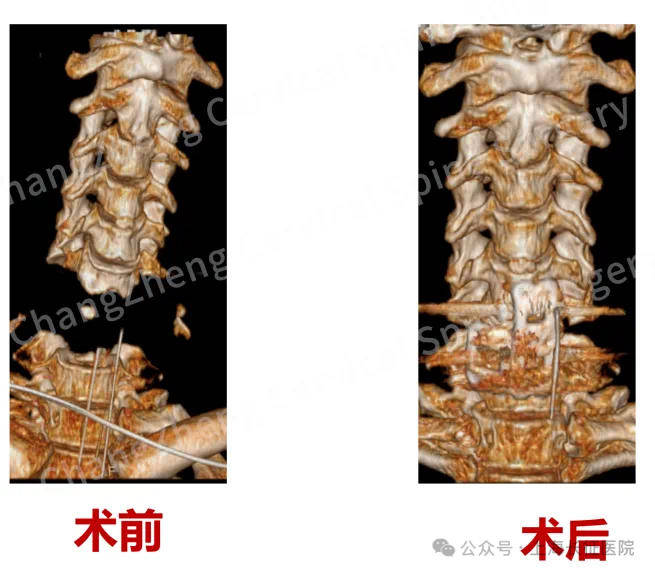 全球罕见！“身首离断”患者被救回 主刀医生：术毕两月整，已脱离呼吸机半月